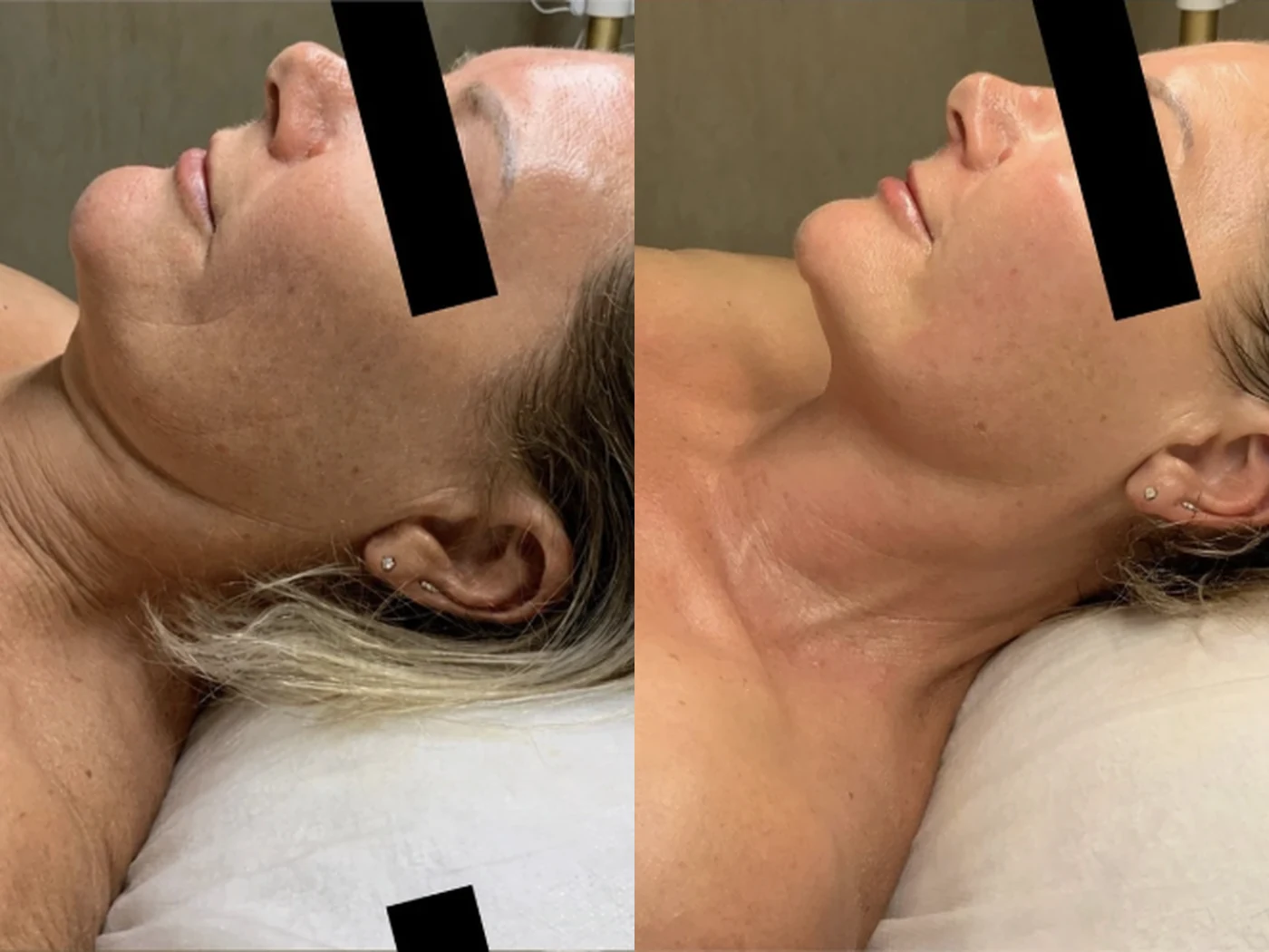 Before and after result 1 from a Saint Serene treatment course
