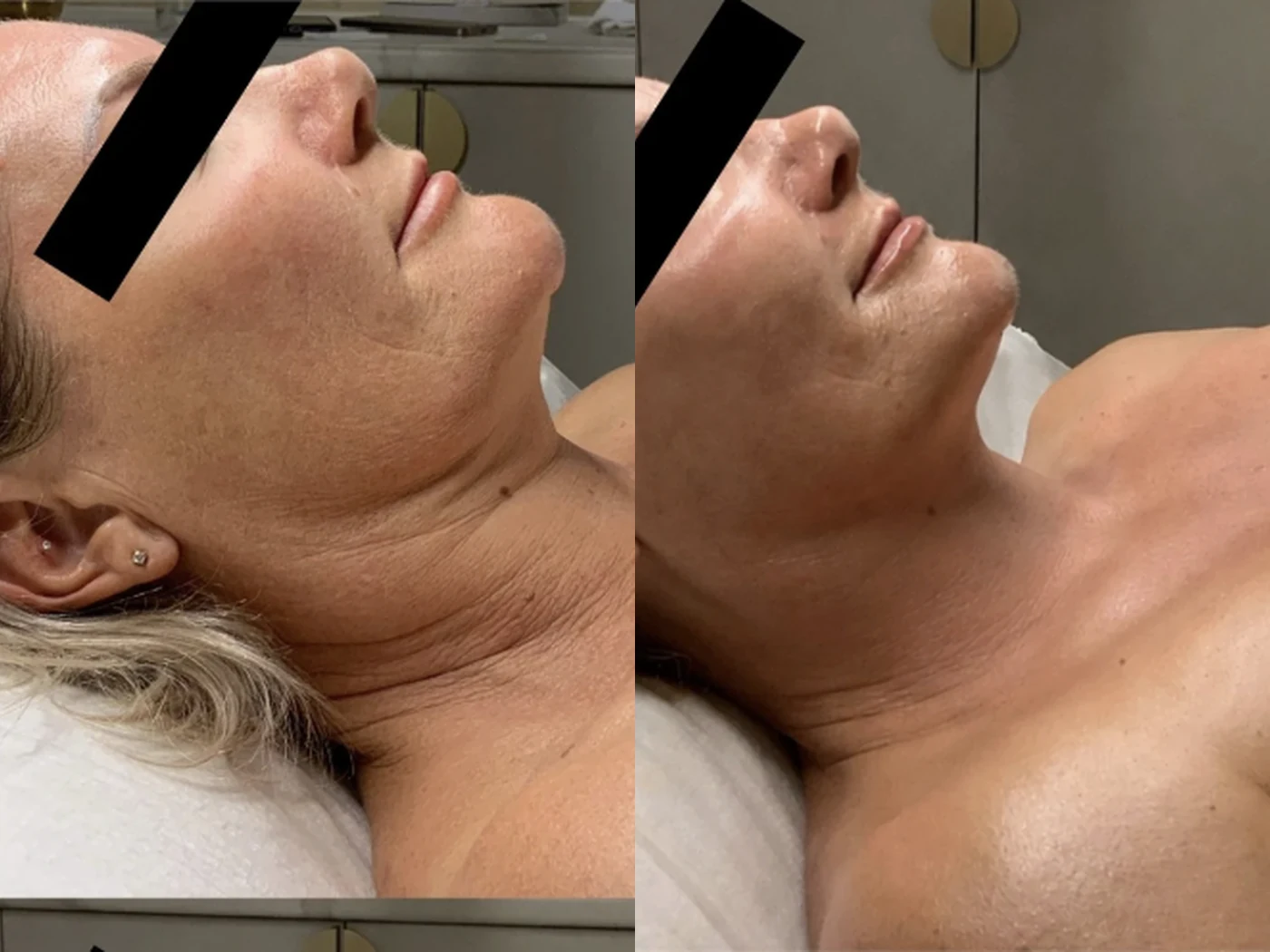 Before and after result 2 from a Saint Serene treatment course