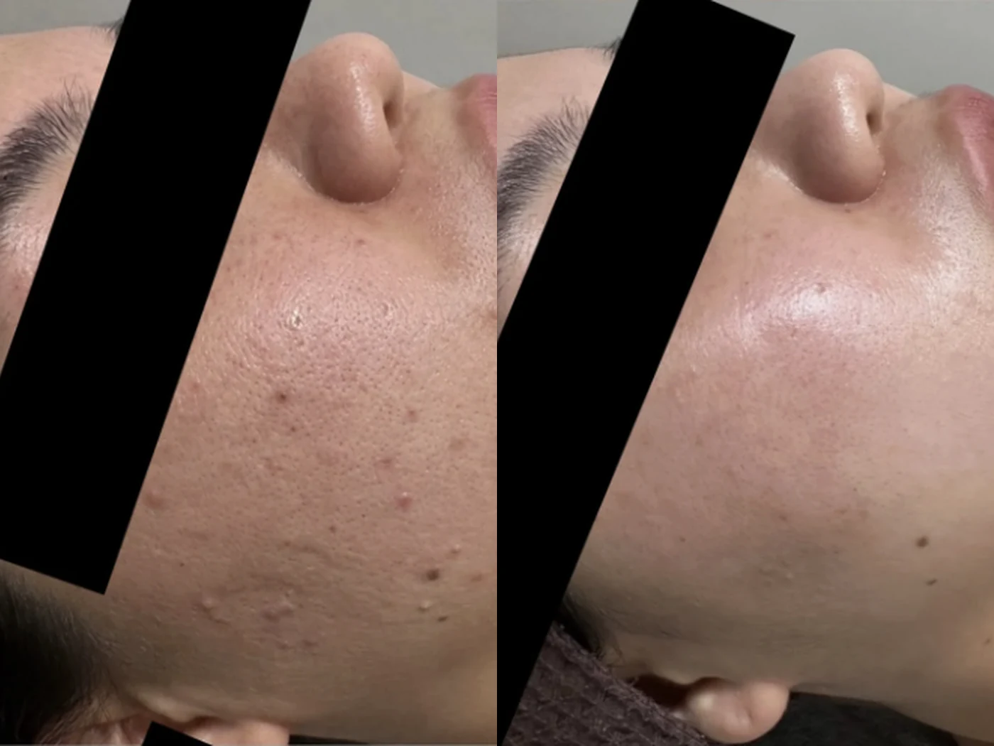 Before and after result 3 from a Saint Serene treatment course