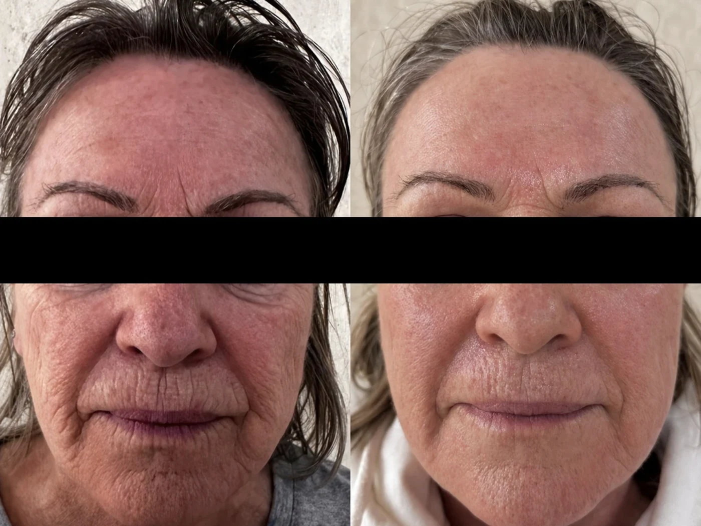 Before and after result 4 from a Saint Serene treatment course