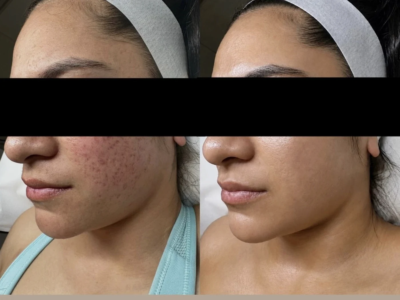 Before and after result 5 from a Saint Serene treatment course