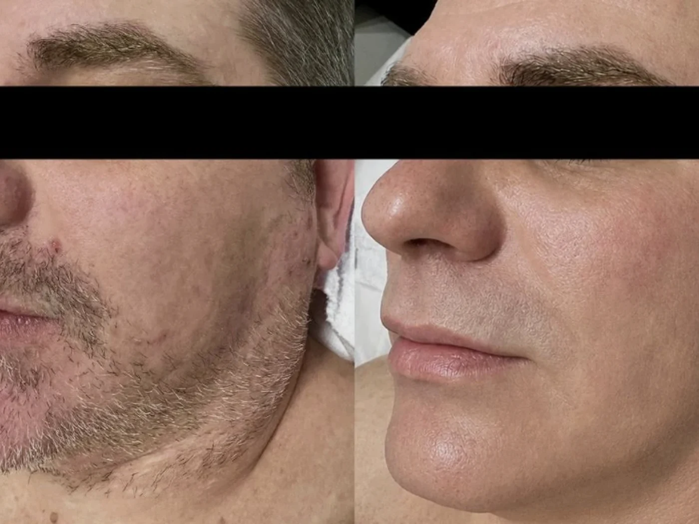Before and after result 7 from a Saint Serene treatment course