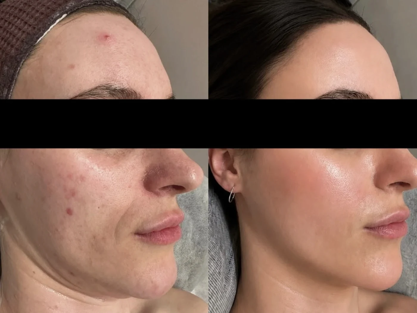 Before and after result 8 from a Saint Serene treatment course