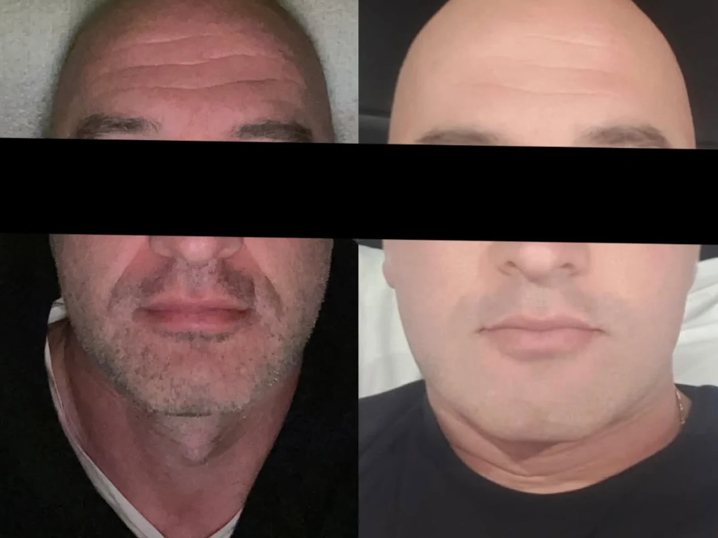 Before and after result 9 from a Saint Serene treatment course